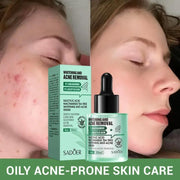 Poppy Gifts Skin Care Sadoer Salicylic Acid Niacinamide Tea Tree Anti Blemish Skincare 5 Piece Set Sadoer Salicylic Acid Niacinamide Tea Tree Set